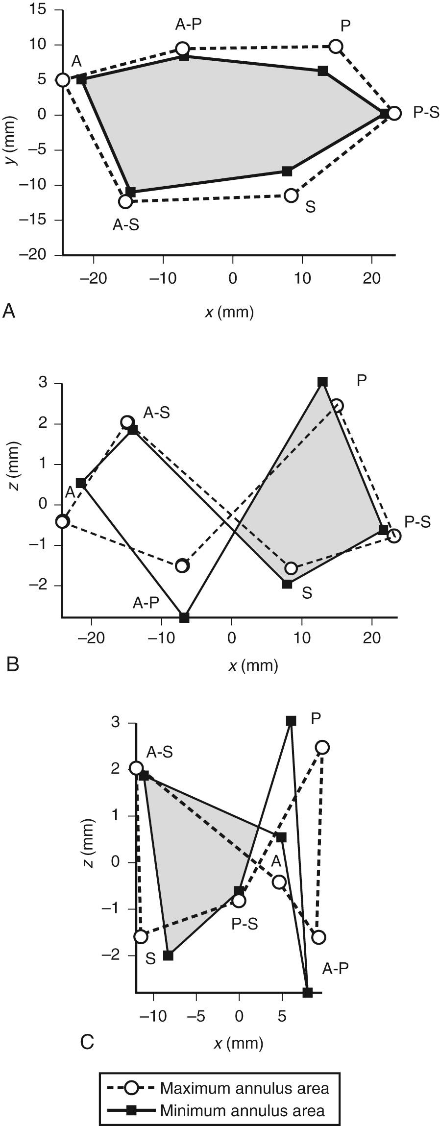 FIGURE 81-2, Geometric changes of the normal tricuspid valve annulus during the cardiac cycle. Orthogonal representations of the tricuspid valve annulus at maximum (dotted line) and minimum (continuous line) area during the cardiac cycle. Circles and squares represent the location of transducers at the midpoint of the bases of the anterior (A), posterior (P), and septal (S) leaflets and at the anteroposterior (A-P), anteroseptal (A-S), and posteroseptal (P-S) commissures. Two relative maxima can be noted in the x-z (B) and y-z (C) planes. P and A-S represent the pommel and the cantle of the tricuspid valve's saddle shape. The representation of the x-y plane is shown in A.