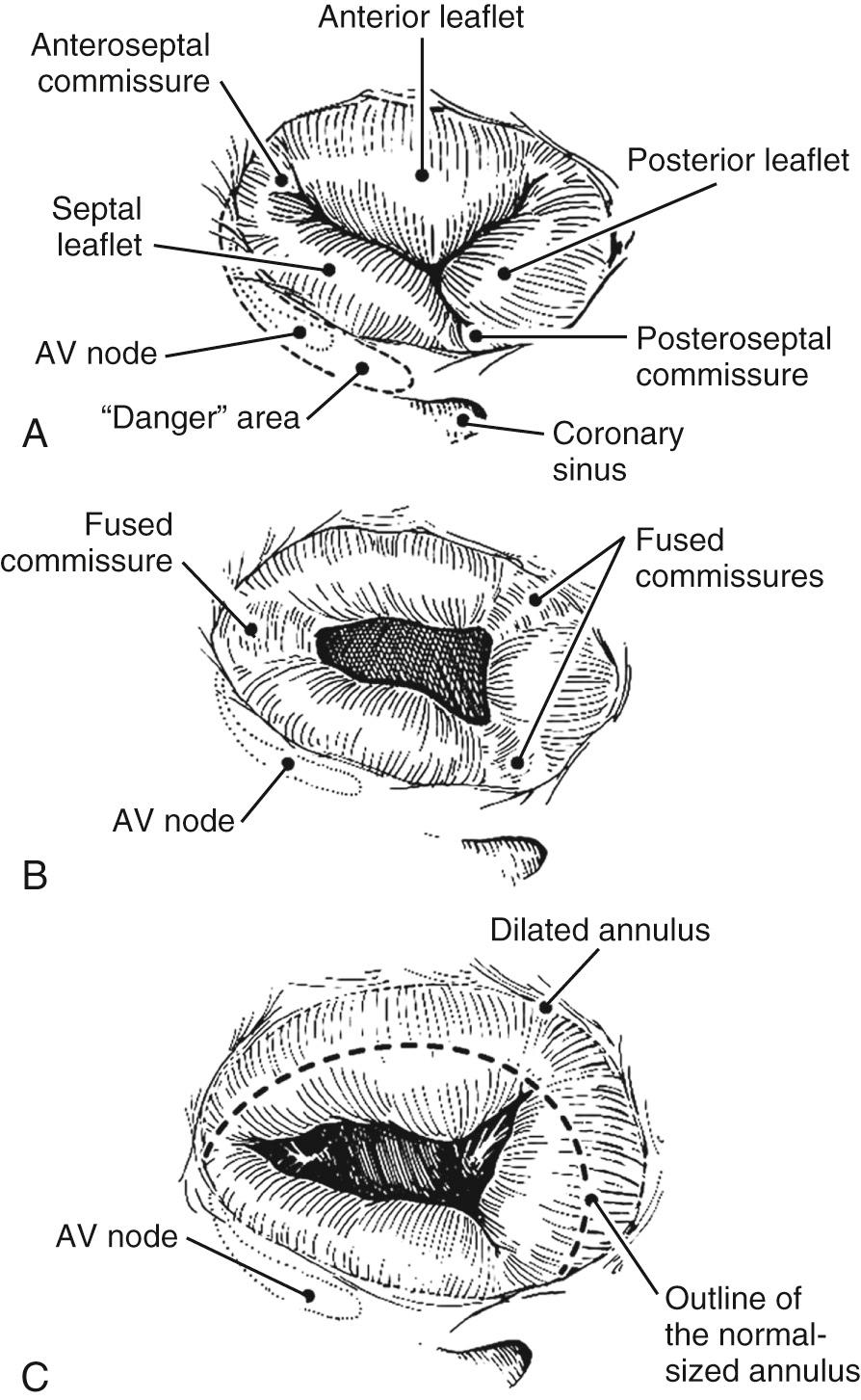 FIGURE 81-3, Atrial view of the normal (A), stenotic (B), and insufficient (C) tricuspid valve. AV, Atrioventricular.