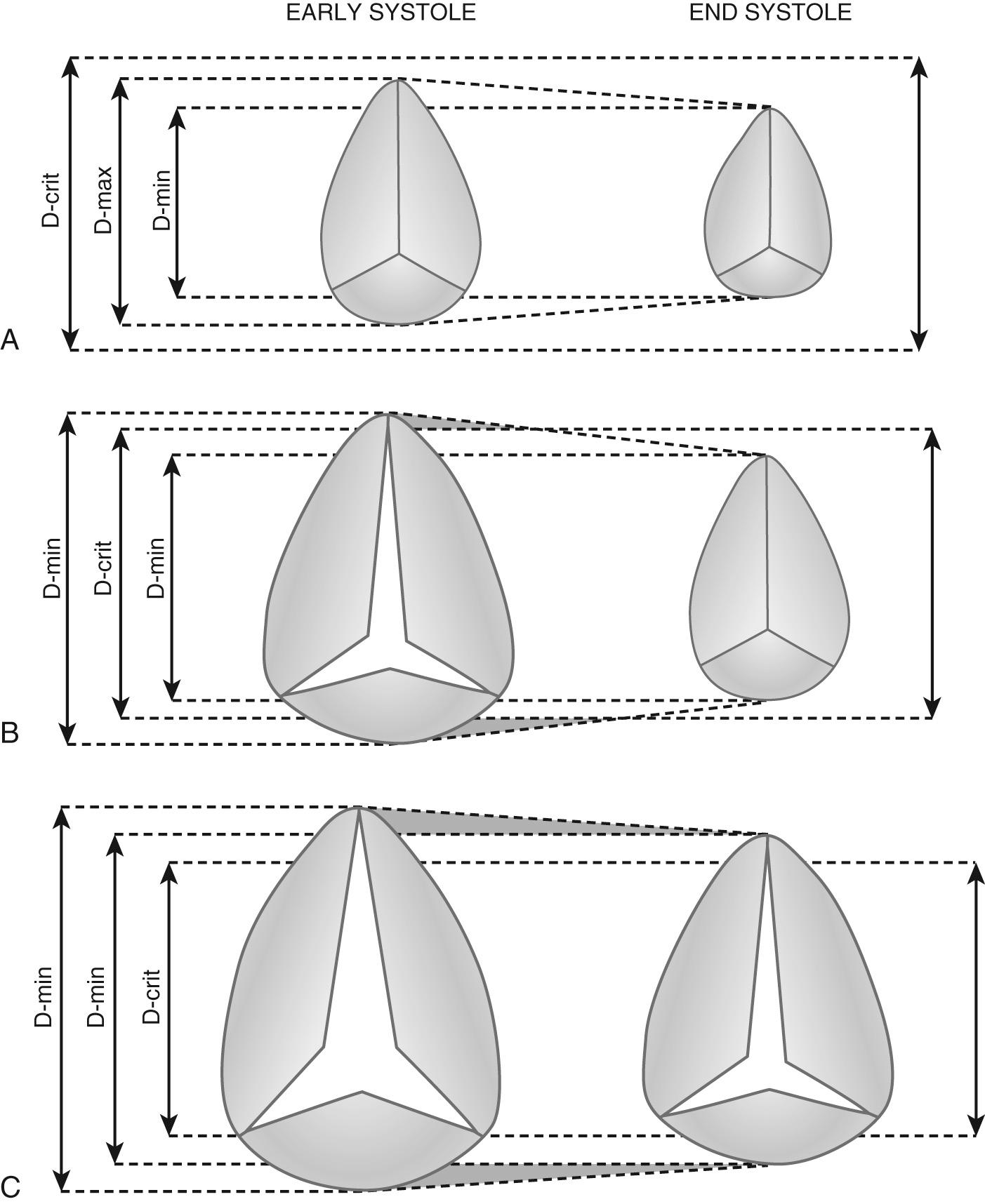 FIGURE 81-6, Diagram of the tricuspid valve. A, Patients without regurgitation. Both maximal early systolic (D-max) and minimal late end-systolic (D-min) diameters are below the critical diameter (D-crit) of 27 mm/m 2 . B, Patients with mild regurgitation. D-max is larger, but D-min is smaller than D-crit. No cusp apposition occurs during early and mid systole. C, Patients with severe regurgitation. D-max and D-min are above D-crit. Pansystolic regurgitation.