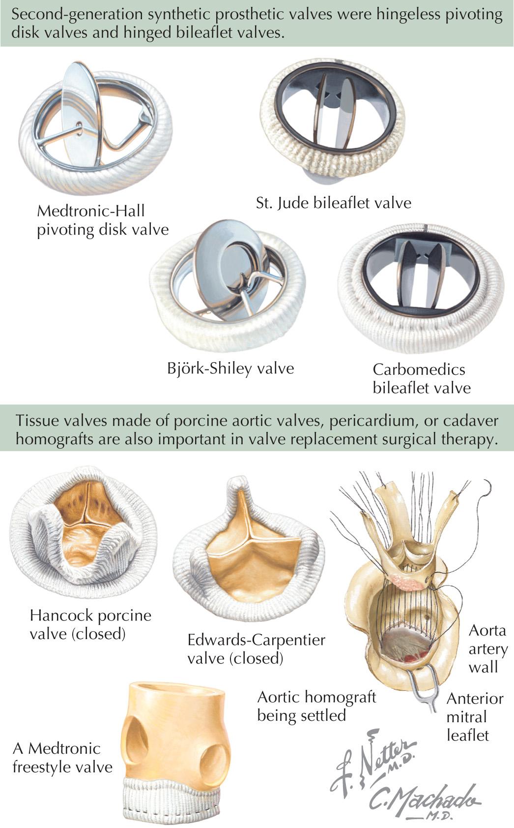 FIG 50.1, Second Generation of Synthetic Prosthetic Valves and Biological Valves.