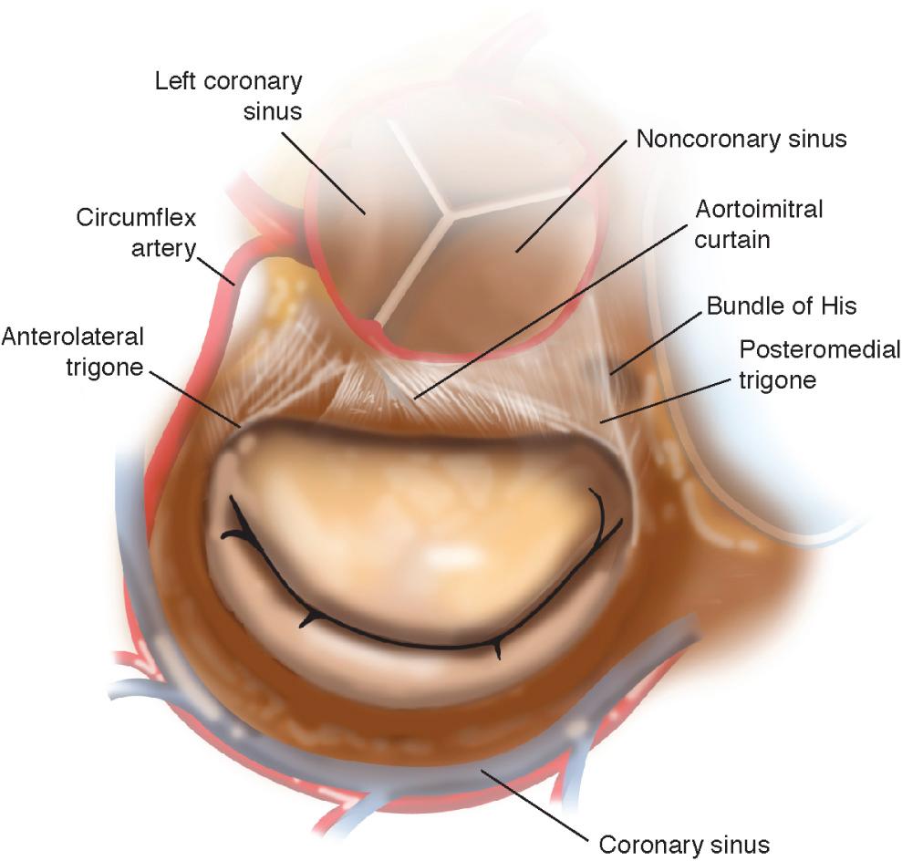 FIGURE 80-1, Surgical anatomy of the mitral valve and other important neighboring structures.