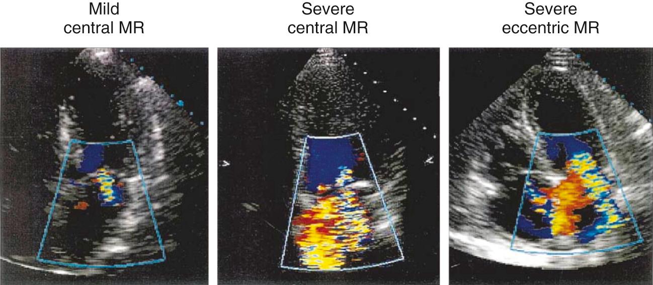 FIGURE 80-11, Examples of color flow recordings of different mitral regurgitation (MR) lesions from the apical window. The case of mild regurgitation has no flow convergence and a small regurgitant jet area, in contrast to that of severe central MR, which shows a prominent flow convergence and large regurgitant jet area. The example with severe eccentric MR has a small jet area impinging on the wall of the left atrium but a large flow convergence and a wide vena contracta.