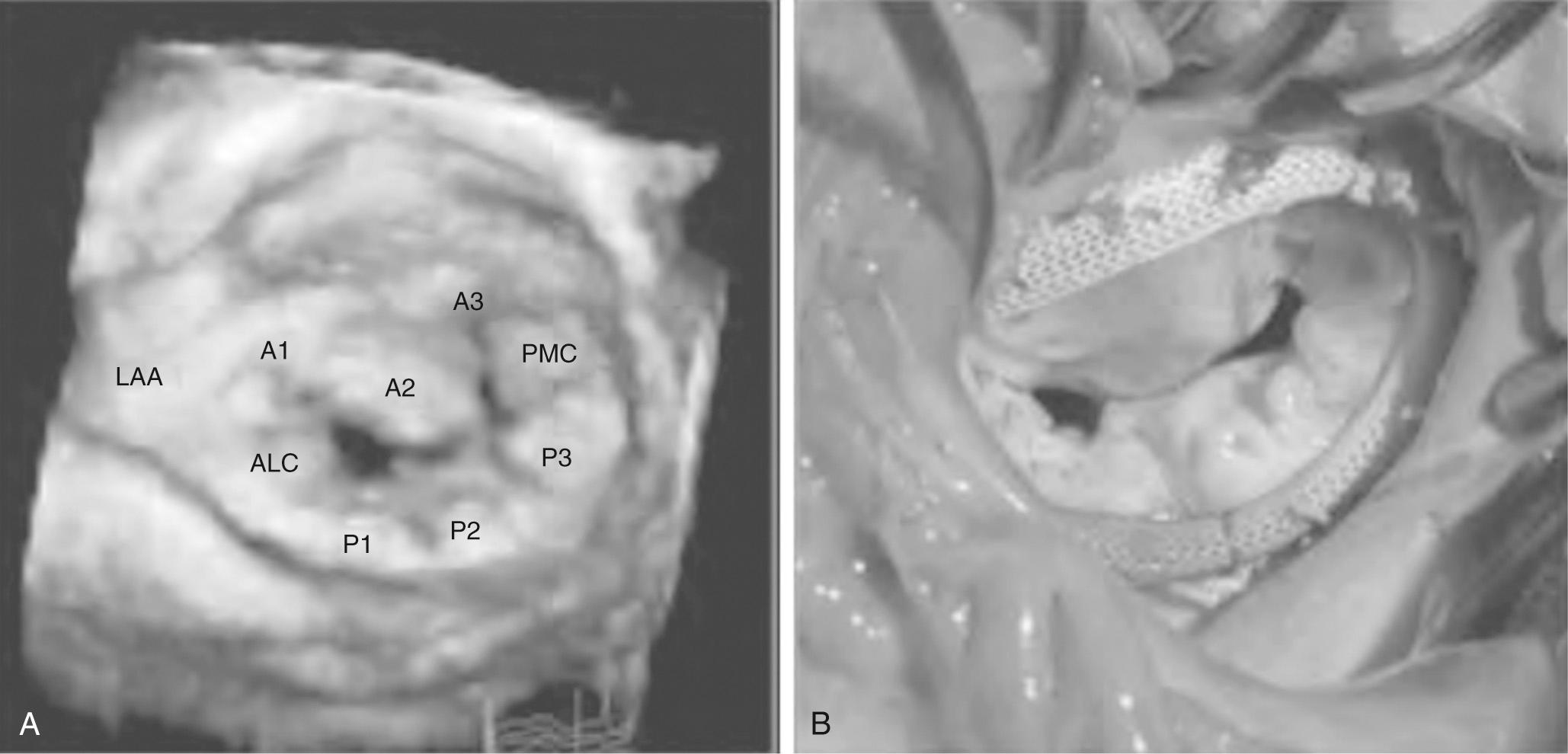 FIGURE 80-2, Segmental anatomy of the mitral valve from the surgical view is demonstrated (A) grossly and (B) with three-dimensional transesophageal echocardiography.