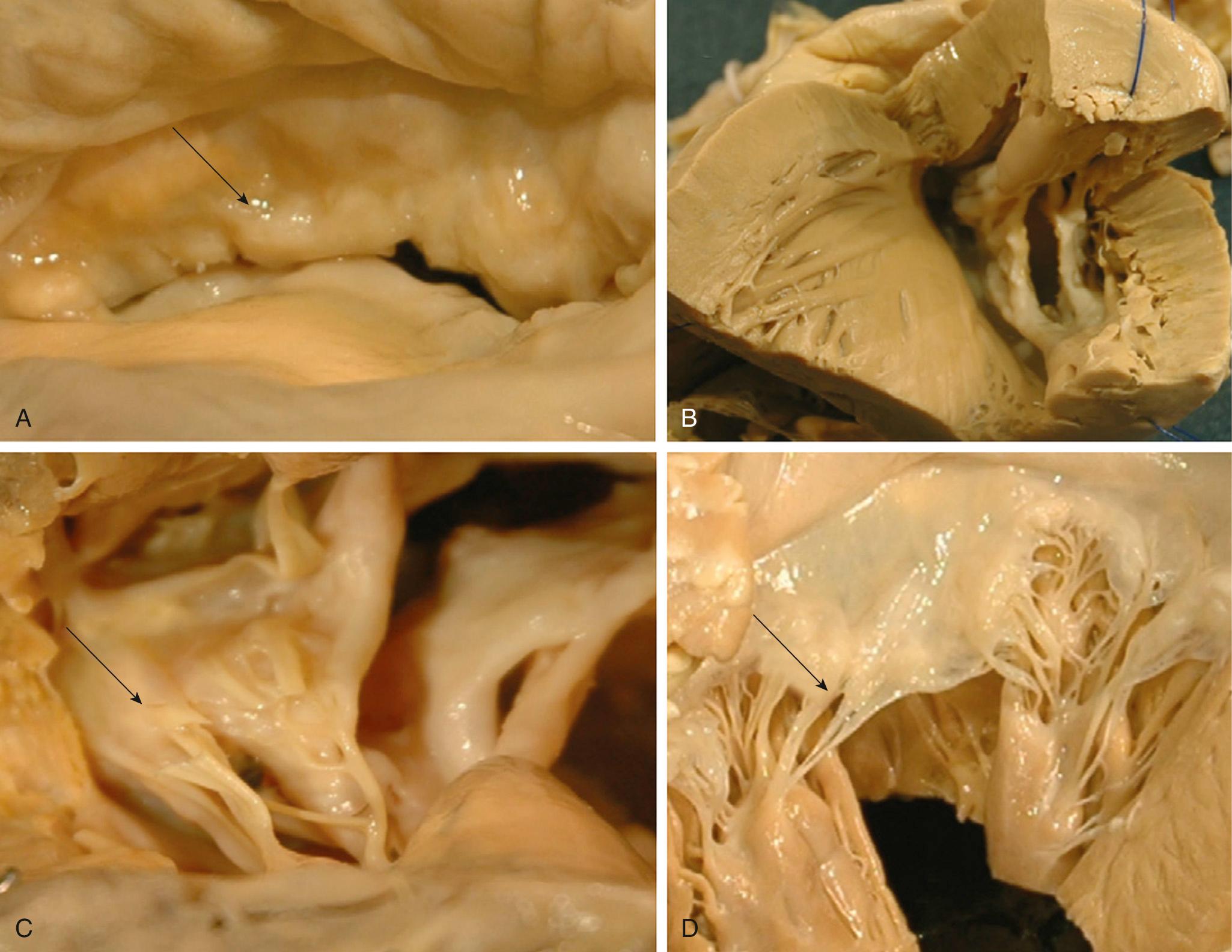 FIGURE 80-4, Pathologic changes of the mitral valve in mitral stenosis. Thickened, rigid, nodular appearance of the mitral valve leaflets as viewed from the atria (A) and ventricle (B). The commissures are calcified and fused, thereby creating the characteristic “fish mouth”–shaped valve. B and C, The subvalvular apparatus is thickened, fused, and shortened. D, Healthy mitral valve leaflets.