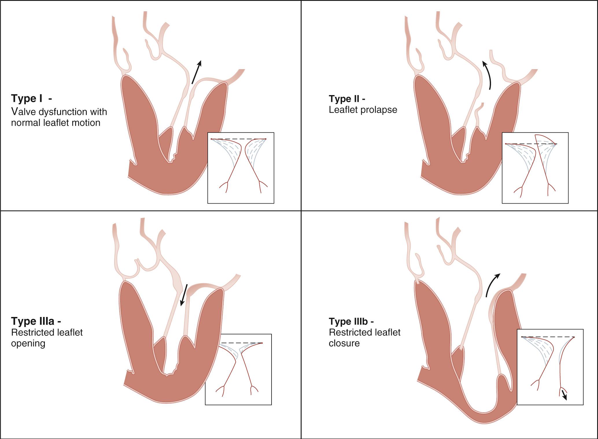 FIGURE 80-7, Carpentier's functional classification of mitral regurgitation: Type I, normal leaflet motion; Type II, increased leaflet motion resulting in prolapse; Type III, restricted leaflet motion; IIIa, during diastole and systole; IIIb, during systole only. The arrow demonstrates the direction of regurgitant flow in types I, II, and IIIb. In type IIIa, the arrow demonstrates the frequent association with coexistent mitral stenosis.