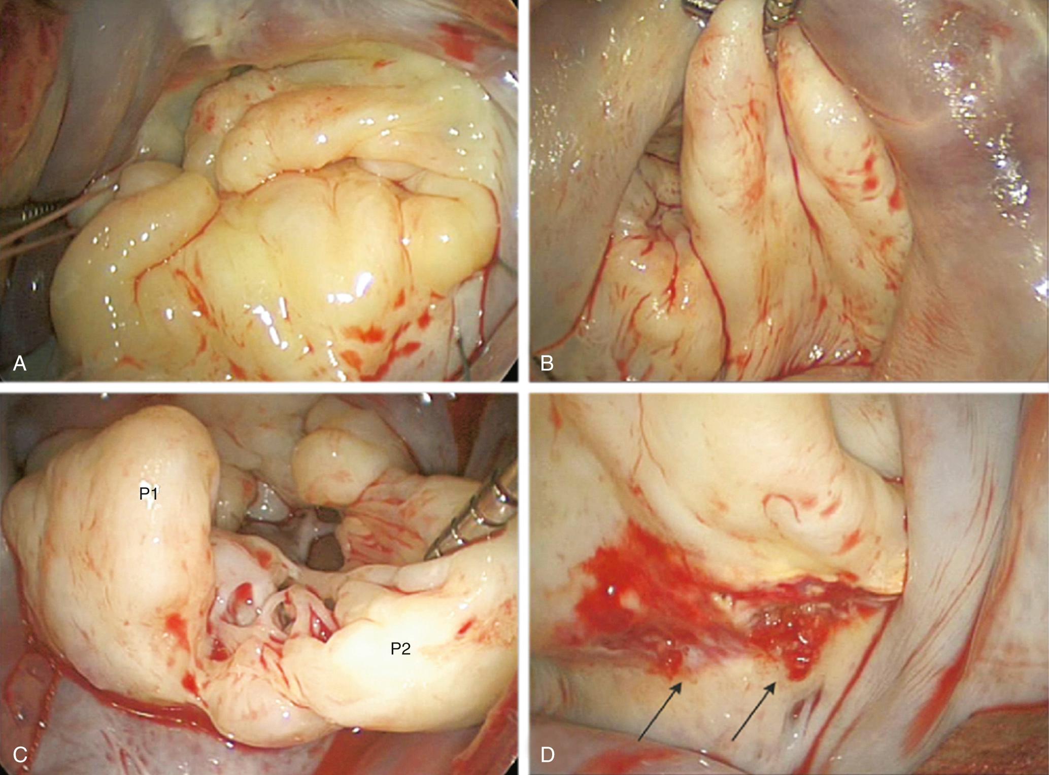 FIGURE 80-9, Surgical lesions in Barlow's disease. A, Large valve with redundant, thick, bulky leaflets. B, Tall, posterior leaflet with tip rising to anterior annulus. C, Calcified anterior papillary muscle with fused, matted chords restricting the P1/P2 junction. D, Atrialization of the base of the posterior leaflet. Note the blurring of the atrial-leaflet junction with fissures and microthrombi (arrows).