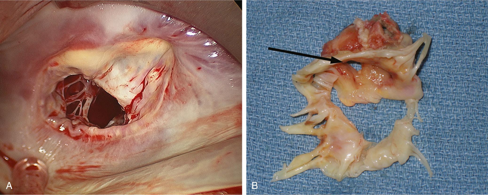 FIGURE 80-10, Surgical lesions in ischemic cardiomyopathy and infective endocarditis. A, A dilated annulus with severe posterior leaflet tethering is characteristic of ischemic mitral regurgitation. B, Perforation (arrow) of the anterior leaflet of the mitral valve secondary to infective endocarditis.