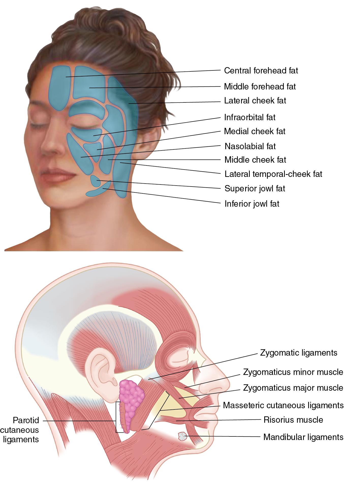 Fig. 10.3, Subcutaneous compartments of the face and their relationship to the zygomaticus major muscle.
