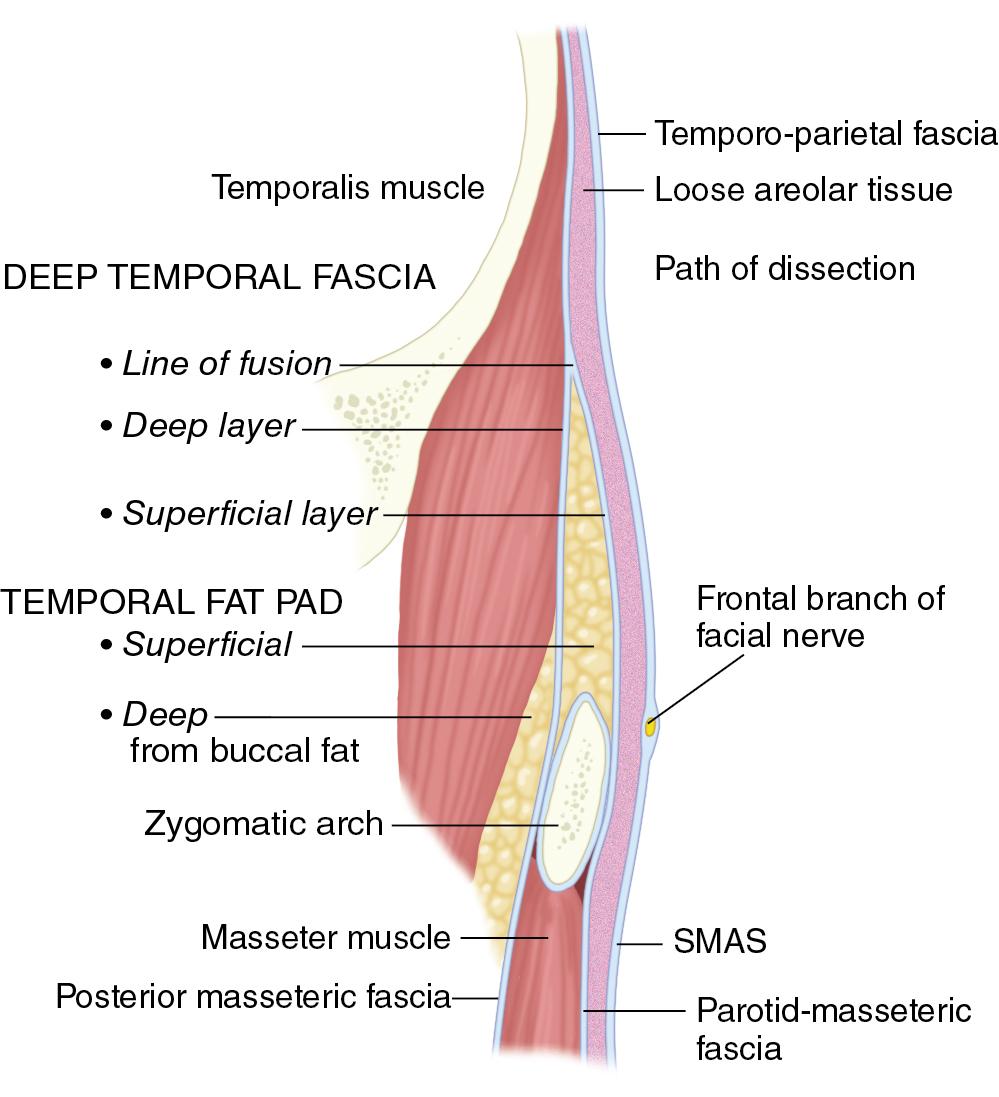 Fig. 10.4, The frontal nerve is deep to the temporal parietal fascia, which is in continuity with the superficial musculoaponeurotic system (SMAS).