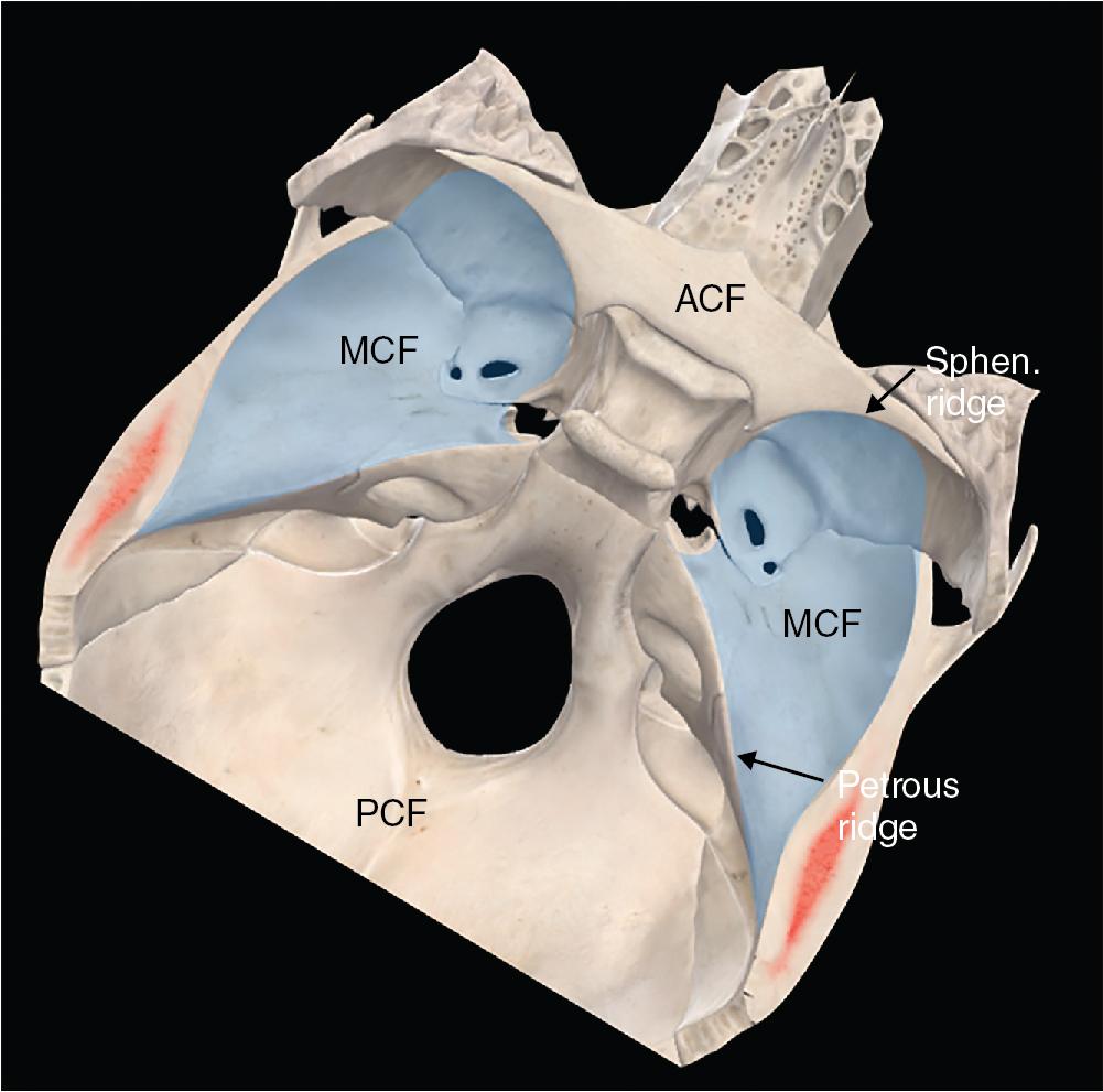 Fig. 7.1, Illustration showing a superior view of skull base anatomy of the middle cranial fossa (MCF). The blue area corresponds with the intracranial surface and boundaries of the MCF between the anterior cranial fossa (ACF) and the posterior cranial fossa (PCF) and the petrous and sphenoid ridges. Sphen, Sphenoid.