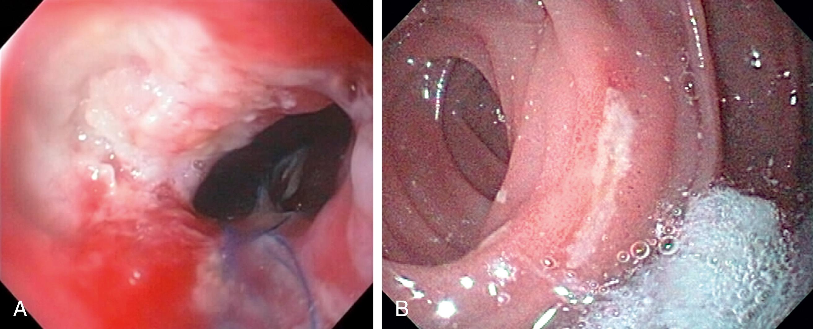 Fig. 8.2, A, Anastomotic ulcer. B, Jejunal ulcer.