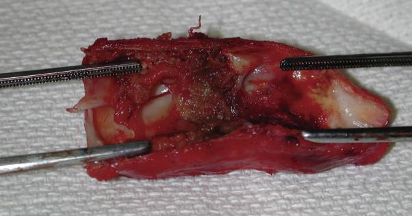 Figure 68-1, Resected anastomosis from an arteriovenous graft demonstrating intimal hyperplasia between the graft on the left and the native vein on the right.