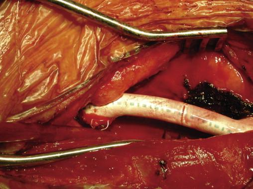 Figure 68-4, An interposition graft is used to bypass a venous anastomotic stenosis because of intimal hyperplasia. However, this type of revision results in loss of the intervening vein segment if a recurrent anastomotic stenosis occurs.