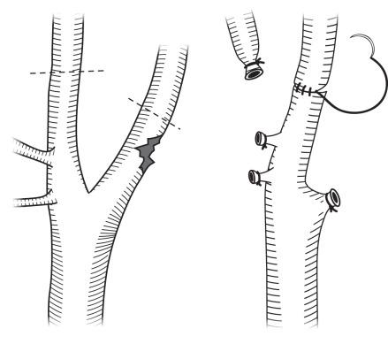 FIG 48.2, External to internal carotid artery bypass.