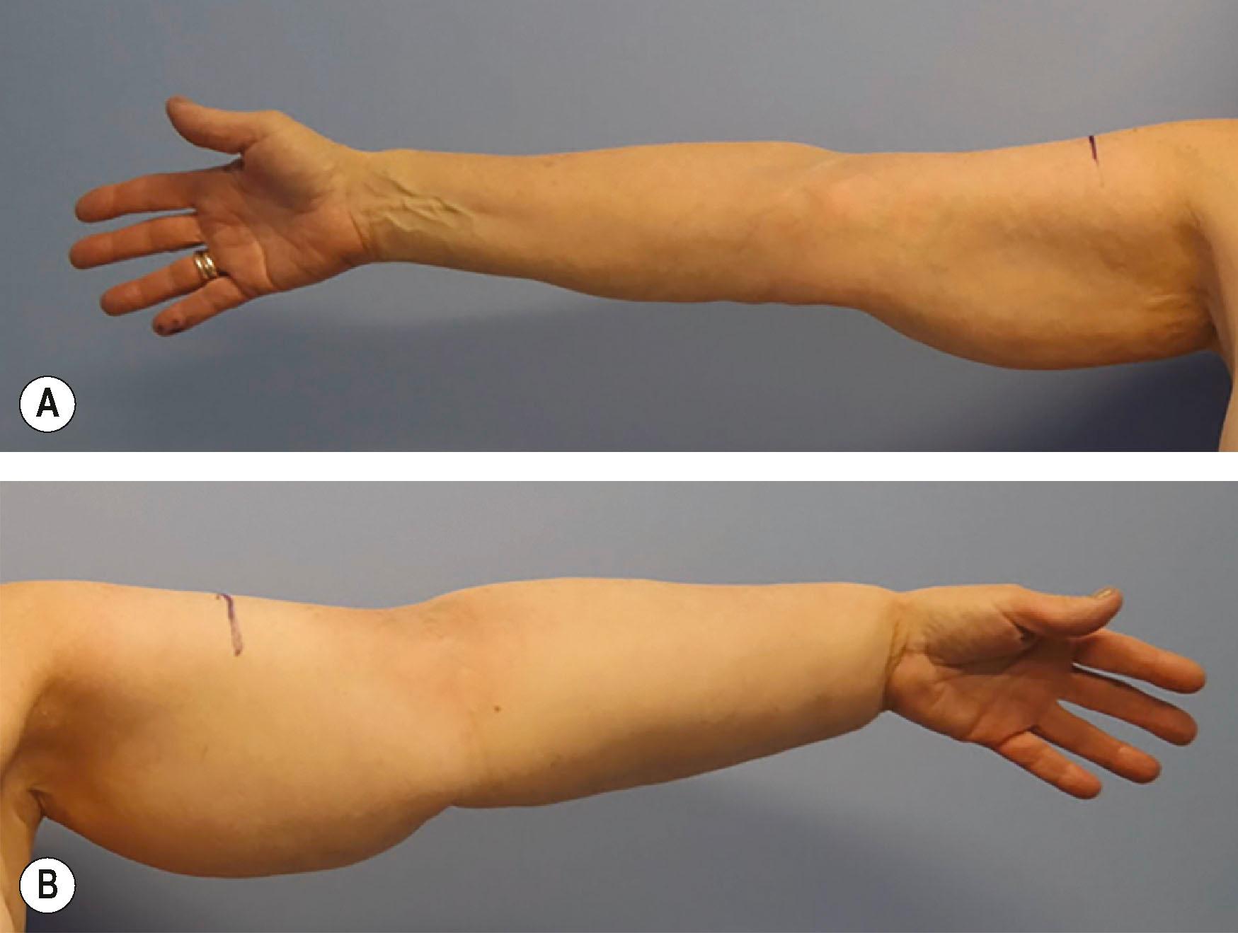 Figure 47.1, Right (A) and left (B) upper extremity of a woman suffering from breast cancer-related lymphedema for over 10 years. She had a volume difference of 2050 mL between her extremities.