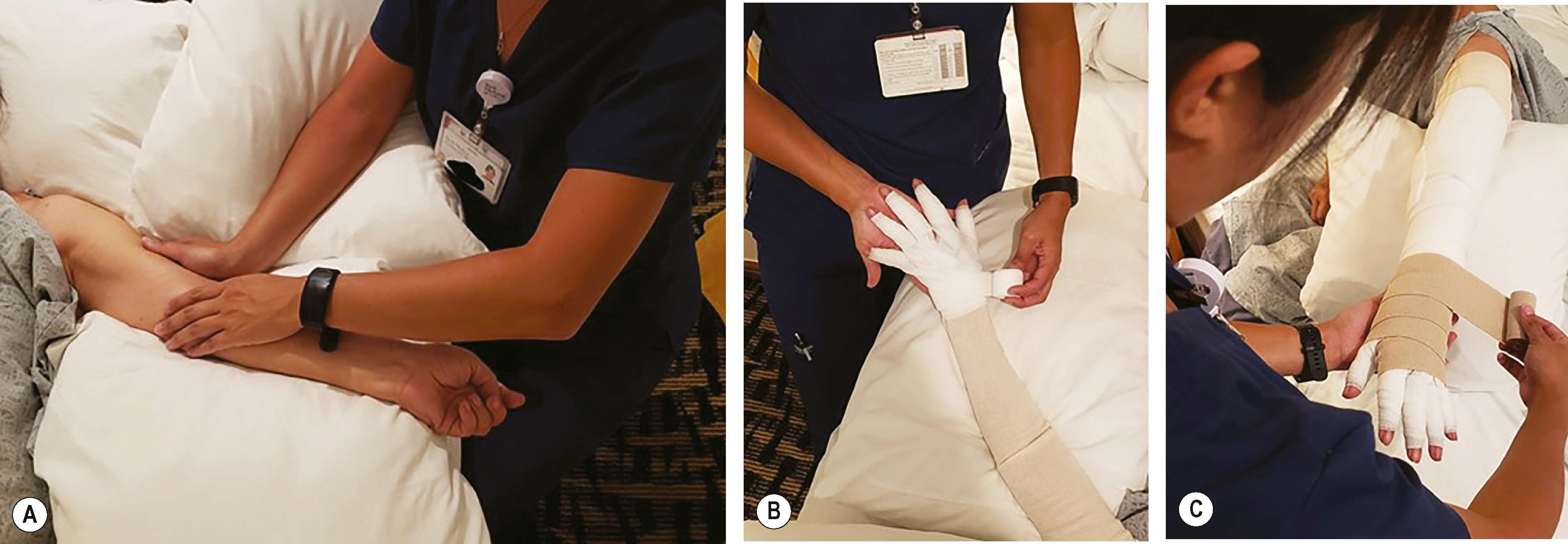 Figure 47.2, (A) Certified lymphedema therapists aid with manual lymphatic drainage. (B,C) Once the limb is adequately decompressed, a series of short-stretch bandages are applied, extending from the digits along the entire length of the extremity. Following the reductive phase of complete decongestive therapy, patients are fitted for compression garments and enter a maintenance phase of lifelong compression.