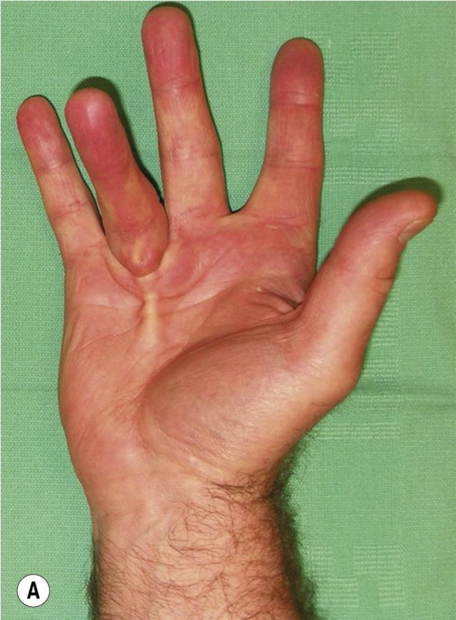 FIGURE 98.1, Distinct visible and palpable pre-tendinous cord in the palm resulting in an MCP joint contracture is an excellent candidate for CCH or needle aponeurotomy.