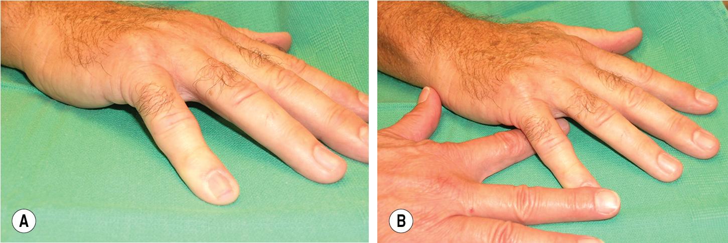 FIGURE 98.3, Table top test demonstrates the inability to place the small finger flush with table due to a PIP joint contracture.