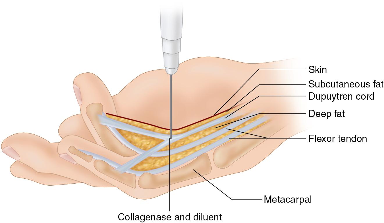 FIGURE 98.5, Coalescence of adjacent cords often occur at the MCP level due to involvement of the natatory ligaments. Consider injection at these Y-shaped cords to address contractures of multiple digits.