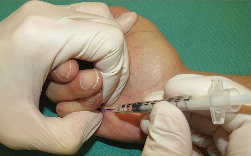 FIGURE 98.7, Use the non-dominant hand fingers to pinch the target cord area to be injected to facilitate appropriate injection location.