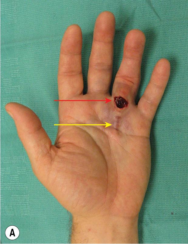 FIGURE 98.9, (A) Skin tears (red arrow) can occur after cord rupture (yellow arrow), (B) but will heal well with local wound care (blue arrow).