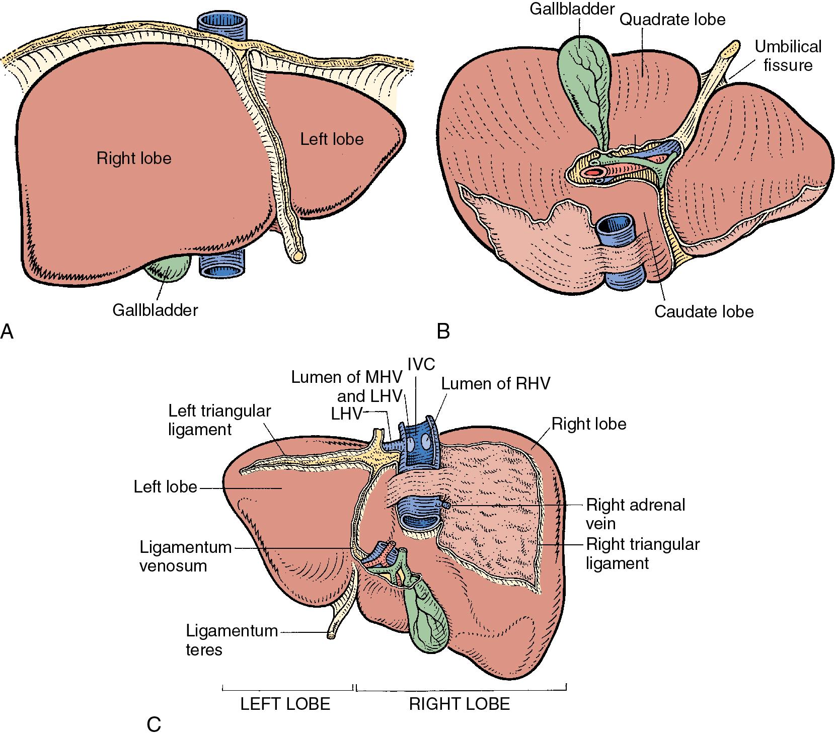 FIGURE 2.1, A, The liver as seen in situ has two main lobes, a large right and a smaller left, and conventional description places their line of fusion on the upper surface of the liver along the attachment of the falciform ligament at the inferior extent of which the ligamentum teres enters the umbilical fissure. B, With the liver flipped upward, the inferior surface of the right lobe is seen as the transverse hilar fissure, which constitutes the posterior limit of this lobe. The portion of the right lobe located anterior to the fissure is called the quadrate lobe , which is limited on the left by the umbilical fissure and on the right by the gallbladder fossa. Posterior to the hilar transverse fissure is a fourth lobe, the caudate lobe , which hugs the inferior vena cava (IVC) and extends upward on its left side. Thus the liver comprises two main lobes and two smaller lobes, separated by visible, well-defined fissures on the liver surface. C, The posterior aspect of the liver is shown. The IVC lies snugly in a deep groove within the bare area; the hepatic veins open directly into it. Within this bare area, the right suprarenal gland lies adjacent to the IVC, and the adrenal vein drains into the right of the IVC. The remainder of the bare area of liver is directly in contact with the diaphragm. To the left of the IVC, the caudate lobe slopes upward from the inferior to the posterior surface of the liver and is demarcated on the left by a fissure, within which lies the ligamentum venosum. The gastrohepatic omentum is attached to the ligamentum venosum, placing the caudate lobe within the lesser sac of the peritoneum. The left lobe of the liver is situated anteriorly in the supracolic compartment of the peritoneal cavity. The posterior surface of the left lobe is narrow; there is a very fine bare area on this side. While the vena cava traverses upward in the groove on the posterior surface of the liver, it is shielded on the right side by a layer of fibrous tissue that passes from the posterior edge of the liver backward toward the lumbar vertebrae and fans out posteriorly, especially in the upper part. Behind the IVC, a prolongation of this fibrous layer joins a less marked fibrous extension from the lateral edge of the caudate lobe. This layer of fibrous tissue, sometimes called the ligament of the vena cava , must be divided on the right, to allow surgical exposure of the IVC and the right hepatic vein, and on the left, to allow mobilization of the caudate lobe. Occasionally, the liver tissue embraces the vena cava completely, so that it runs within a tunnel of parenchyma. LHV, Left hepatic vein; MHV, middle hepatic vein; RHV, right hepatic vein.