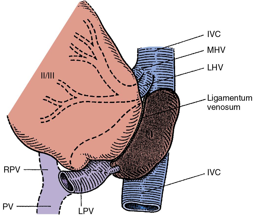 FIGURE 2.12, The caudate lobe (shaded) and segments II and III, rotated to the patient’s right. Superiorly, the left portion of the caudate lobe is linked by a deep anterior portion, embedded in the parenchyma immediately under the middle hepatic vein (MHV), reaching inferiorly to the posterior margin of the hilus of the liver and fusing anterolaterally to the inferior vena cava (IVC) on the right side to segments VI and VII of the right liver. The major blood supply arises from the left branch of the left portal vein (LPV) and the left hepatic artery, close to the base of the umbilical fissure of the liver. The hepatic veins (MHV, LHV) are short in course and drain from the caudate directly into the anterior and left aspect of the vena cava. LHV, Left hepatic vein; PV, main trunk of portal vein; RPV, right portal vein;