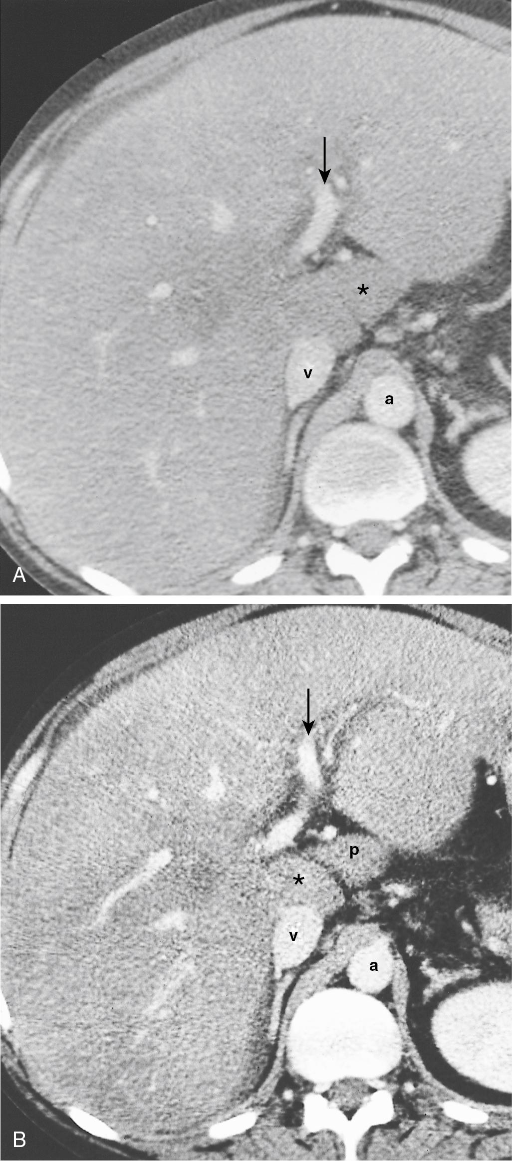 FIGURE 2.13, Computed tomographic image of the caudate lobe with papillary process.