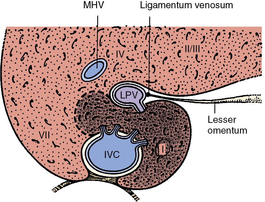 FIGURE 2.11, The main bulk of the caudate lobe (segment I; dark area ) lies to the left of the inferior vena cava (IVC); the left and inferior margins are free in the lesser omental bursa. The gastrohepatic (lesser) omentum separates the left portion of the caudate from segments II and III of the liver, while it passes between them to be attached to the ligamentum venosum. The left portion of the caudate lobe inferiorly traverses to the right between the left portal vein (LPV) and IVC as the caudate process, where it fuses with the right lobe of the liver. Note the position of the middle hepatic vein (MHV).