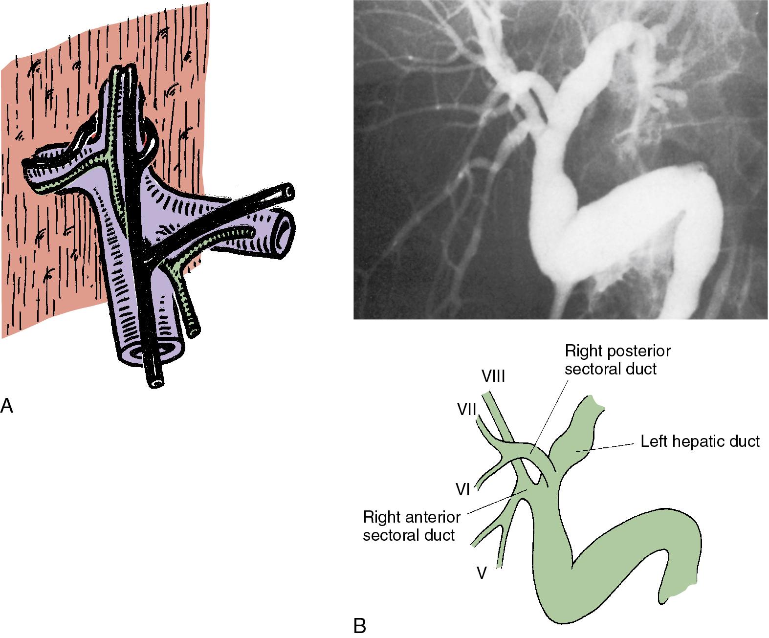 FIGURE 2.16, A, Biliary and vascular anatomy of the right liver. Note the horizontal course of the posterior sectional duct and the vertical course of the anterior sectional duct. B, Trans-tubal cholangiogram shows a common normal variant: the right posterior sectional duct drains into the left hepatic duct. In this case, the posterior duct is anterior to the posterior sectional duct. Frequently in this variant, the posterior duct passes posteriorly to the anterior sectional pedicle.