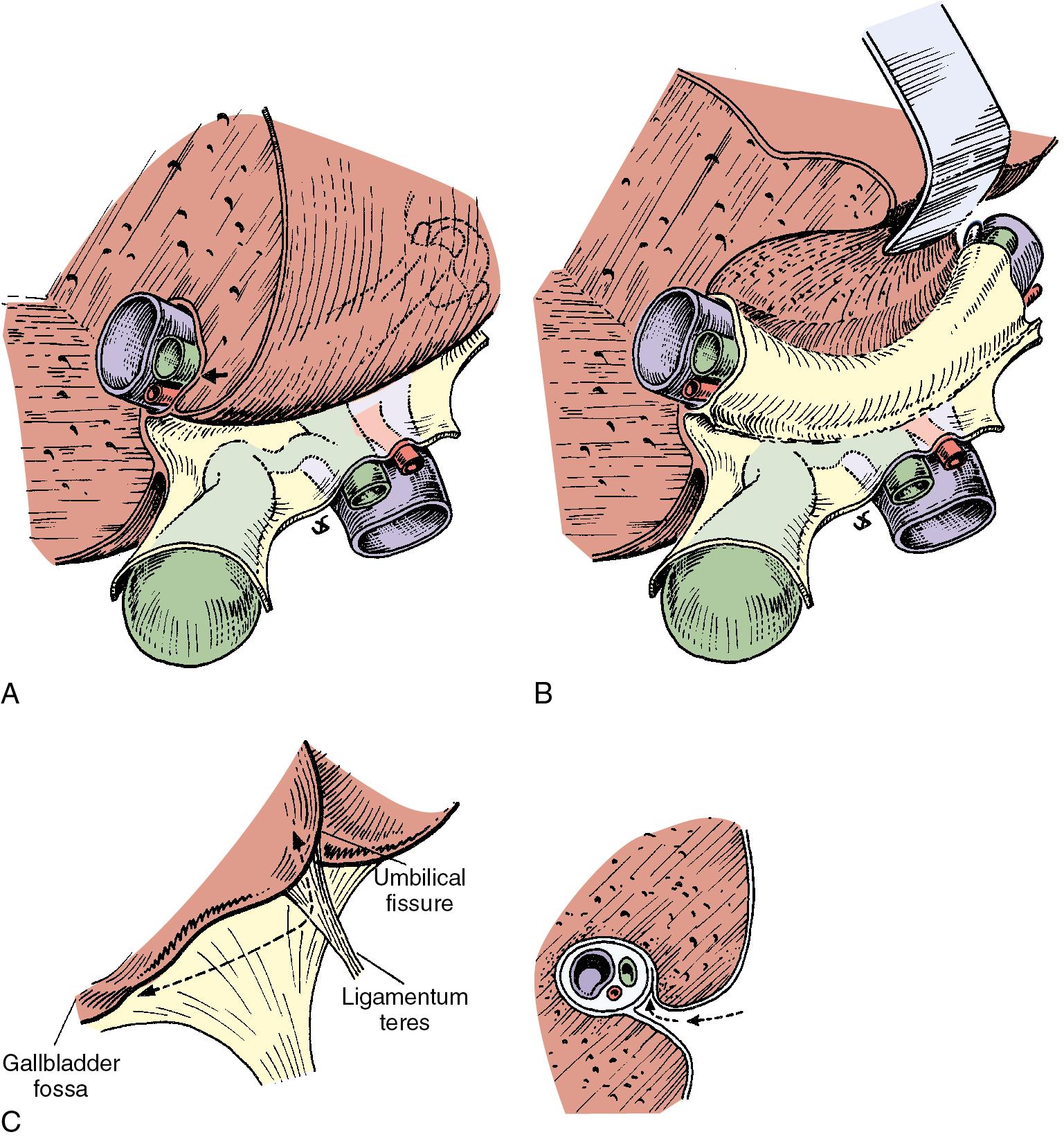 FIGURE 2.20, A, Relationship between the posterior aspect of segment IV and the biliary confluence. The hilar plate (arrow) is formed by the fusion of the connective tissue enclosing the biliary and vascular elements with the Glisson capsule. B, Biliary confluence and left hepatic duct exposed by lifting segment IV upward after incision of the Glisson capsule at its base. This technique, lowering of the hilar plate , generally is used to display a dilated bile duct above an iatrogenic stricture or hilar cholangiocarcinoma. C, Line of incision (left) to allow extensive mobilization of segment IV. This maneuver is of particular value for high bile duct strictures and in the presence of liver atrophy or hypertrophy. The procedure consists of lifting segment IV upward ( A and B ), then not only opening the umbilical fissure but also incising the deepest portion of the gallbladder fossa. Right , Incision of the Glisson capsule to gain access to the biliary system (arrow).