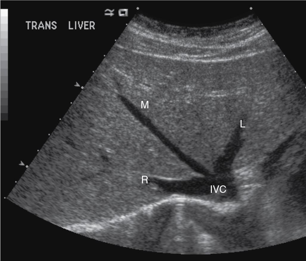 FIGURE 2.2, Transverse ultrasound image of the hepatic vein confluence shows the left (L), middle (M), and right (R) hepatic veins as they join the inferior vena cava (IVC).