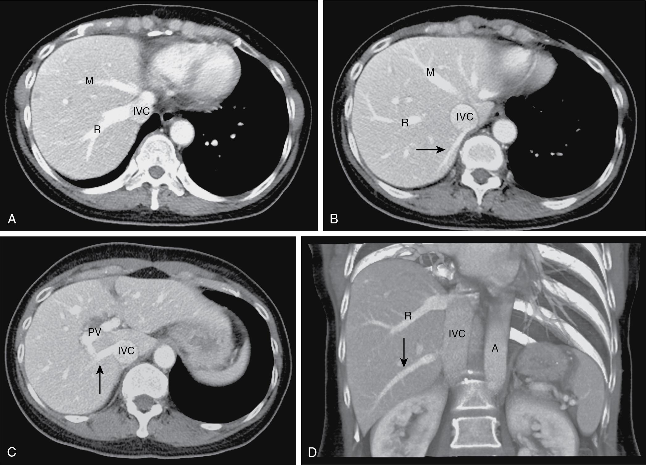 FIGURE 2.3, Two inferior accessory right hepatic veins.