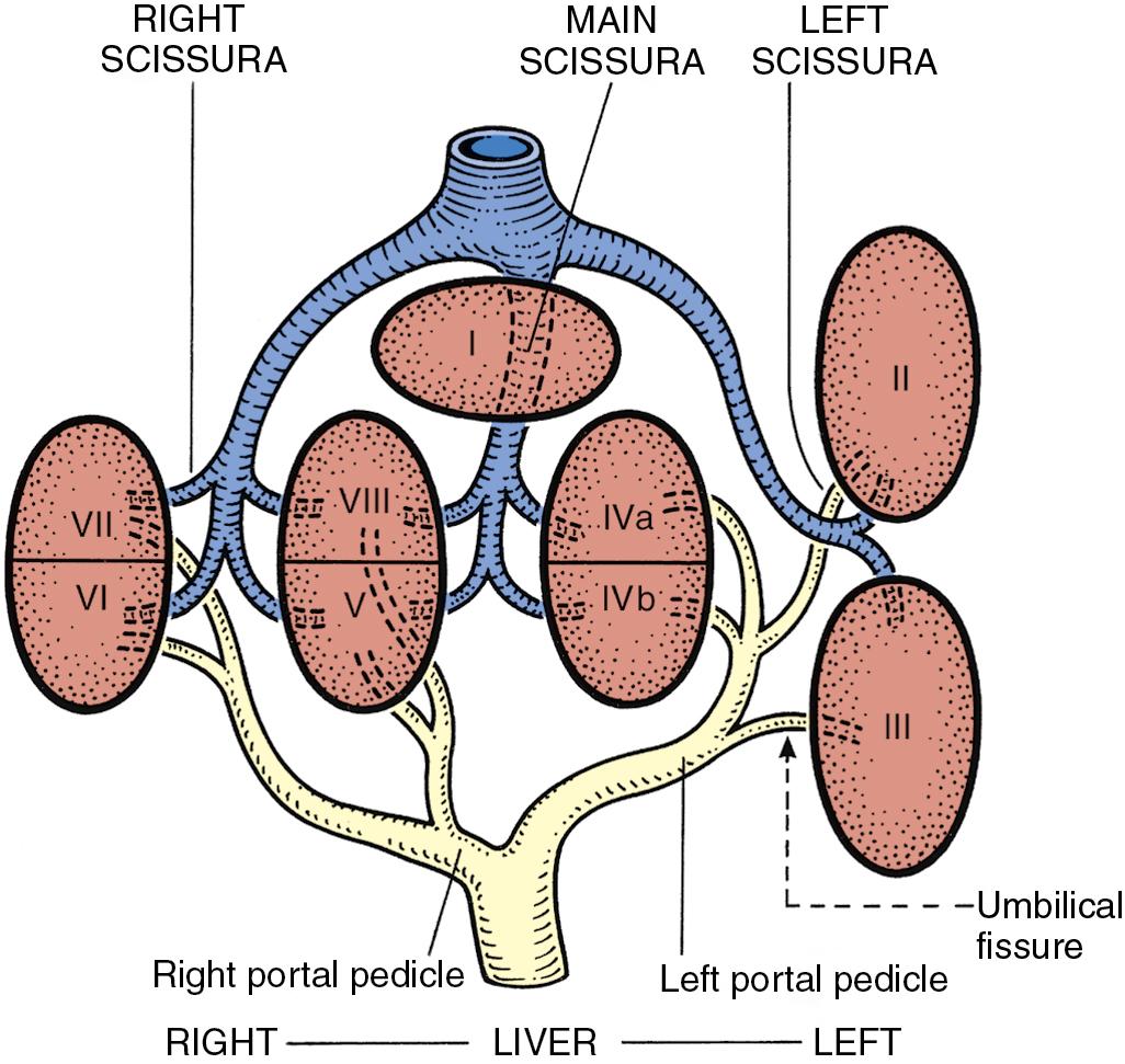 FIGURE 2.5, The portal vein, hepatic artery, and draining bile ducts are distributed within the liver in a beautifully symmetric pedicular pattern, which belies the asymmetric external appearance. Each segment (I to VIII) is supplied by a portal triad composed of a branch of the portal vein and hepatic artery and drained by a tributary of the right or left main hepatic ducts. The four sectors demarcated by the three main hepatic veins are called the portal sectors (now referred to as sections in the Brisbane terminology); these portions of parenchyma are supplied by independent portal pedicles. The hepatic veins run between the sectors in the portal scissurae; the scissurae containing portal pedicles are called the hepatic scissurae . The umbilical fissure corresponds to a hepatic scissura. The internal architecture of the liver consists of two hemilivers, the right and the left liver separated by the main portal scissura, also known as Cantlie’s line . It is preferable to call them the right and left liver rather than the right and left lobes because the latter nomenclature is erroneous; there is no visible mark that permits identification of a true hemiliver.