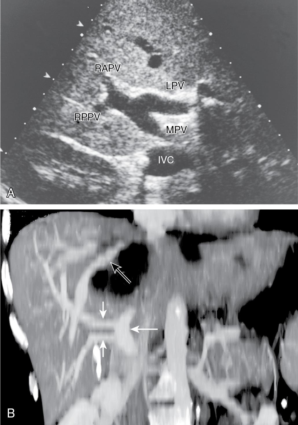 FIGURE 2.7, A, Transverse sonogram at the level of the portal vein bifurcation. The main portal vein (MPV) bifurcates into the left and right portal veins ( LPV and RPV ). The RPV bifurcates shortly into the right anterior (RAPV) and right posterior (RPPV) branches, but the LPV has a longer horizontal course within the hilar plate. The inferior vena cava (IVC) is seen posteriorly. B, Coronal view of computed tomographic angioportography. Reconstruction shows the right hepatic vein (open arrow) and the portal vein (large arrow) ; anterior and posterior sectional branches of the RPV (small arrows) are seen to arise directly and separately from the main portal trunk.