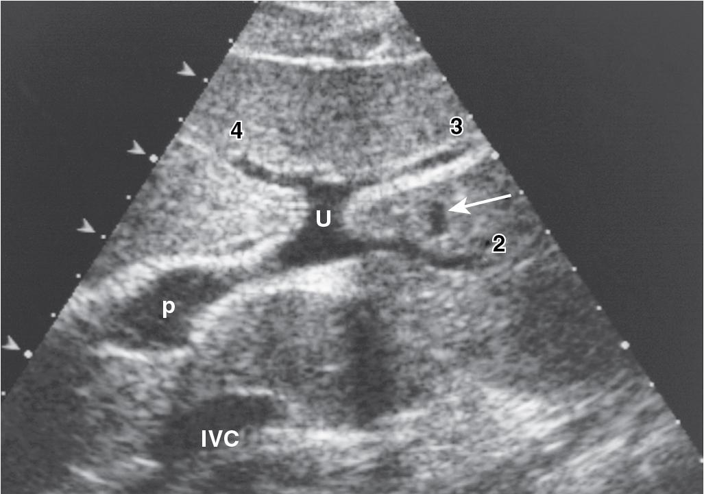 FIGURE 2.8, Transverse sonogram shows the branching pattern of the left portal vein (P), which courses horizontally and into the umbilical fissure. The umbilical portion of the left portal vein (U) gives branches to the left hepatic segments (2 to 4). The left hepatic vein (arrow) and inferior vena cava (IVC) also are shown.