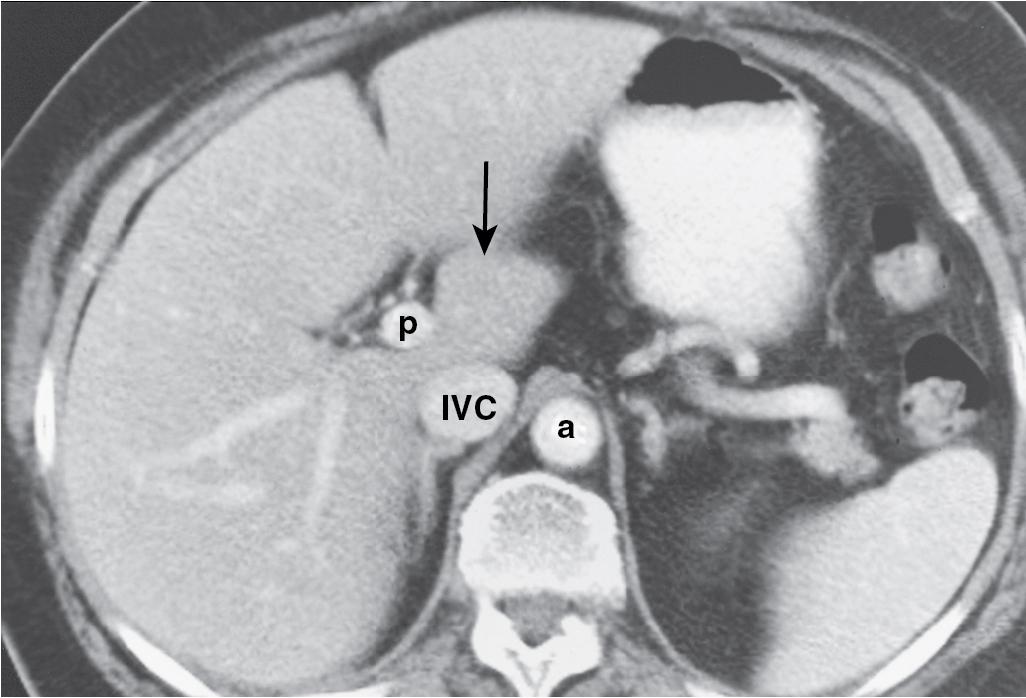 FIGURE 2.10, Contrast-enhanced computed tomographic scan of the liver shows the intimate relationship of the caudate lobe (arrow), inferior vena cava (IVC), portal vein (p), and aorta (a).