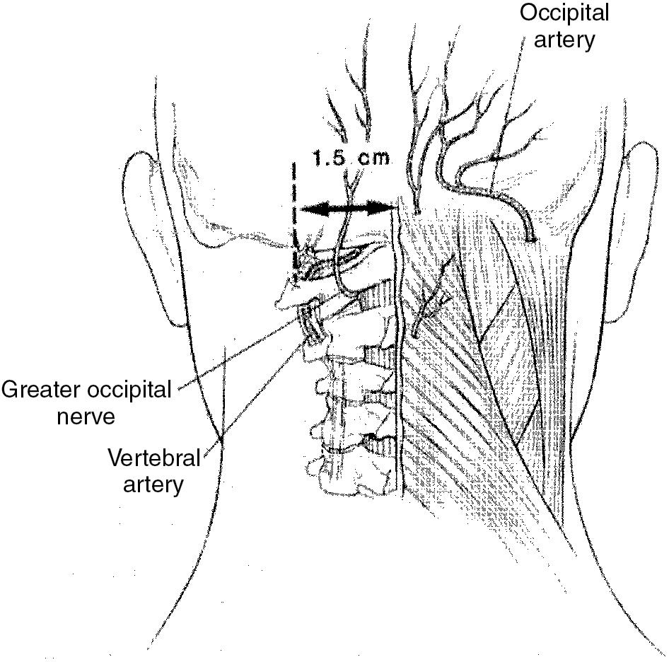 Fig. 26.2, Vertebral artery.