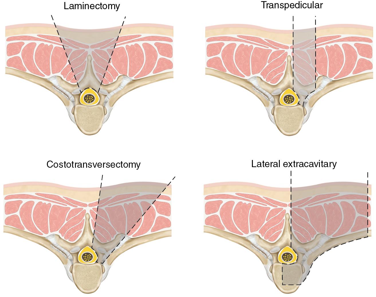 Fig. 27.4, Posterolateral thoracic spinal approaches: laminectomy, transpedicular, costotransversectomy, lateral extracavitary.