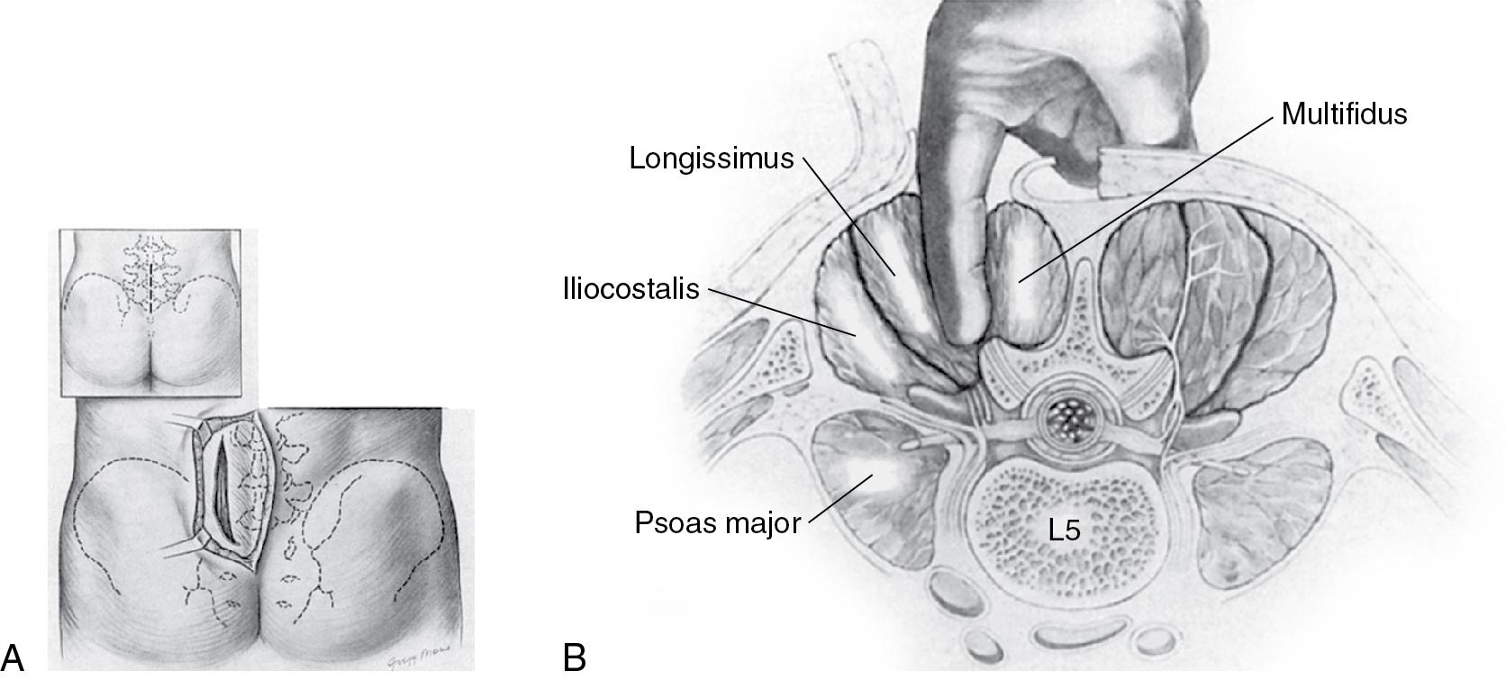 Fig. 27.5, Lumbar paraspinal approach.