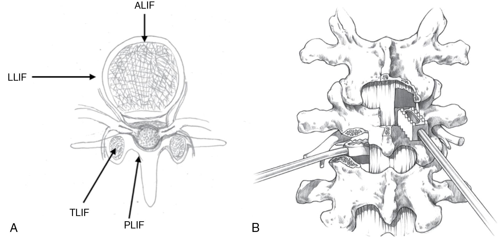 Fig. 27.6, (A) Surgical approaches for interbody fusion: anterior lumbar interbody fusion (ALIF) , lateral lumbar interbody fusion (LLIF) , transforaminal lumbar interbody fusion (TLIF) , and posterior lumbar interbody fusion (PLIF) . (B) Placement of an intervertebral body fusion device from a posterior surgical approach with PLIF (above, right) versus TLIF (below, left) .