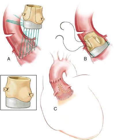 Fig. 14.6, Stentless Porcine Root Replacement Using a Modified SubCoronary Technique.