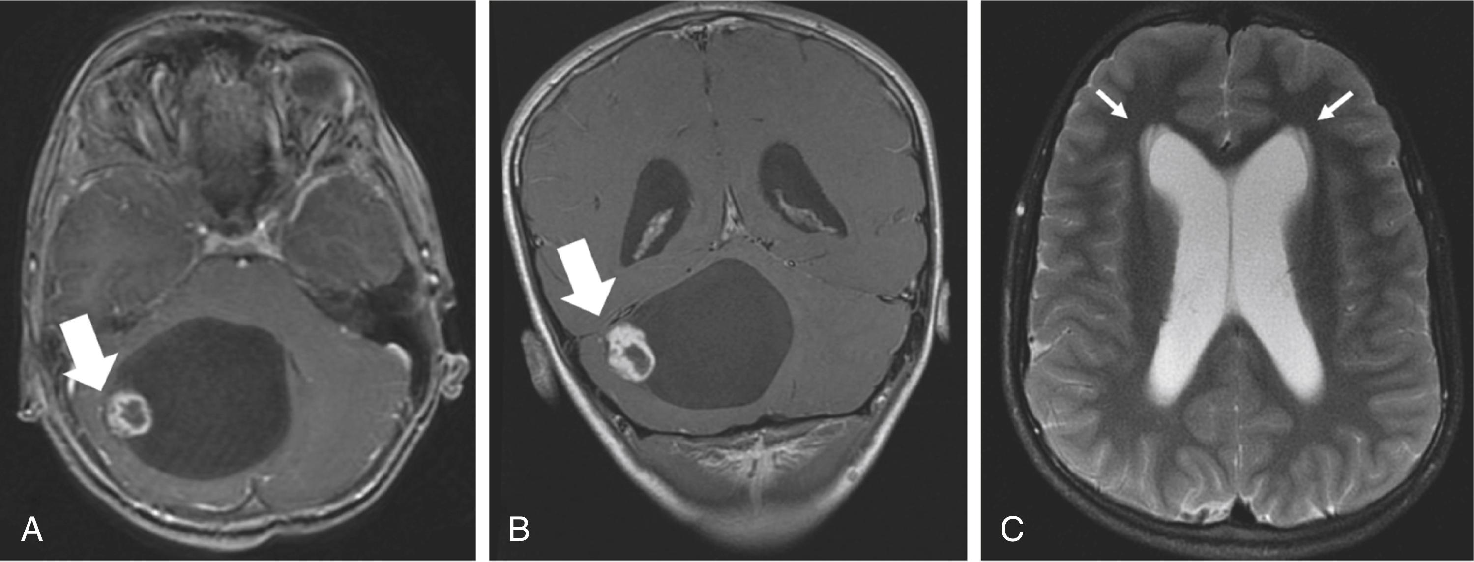 Fig. 2.1, Contrast-enhanced MRI scan of a right cerebellar juvenile pilocytic astrocytoma. (A) Contrast-enhanced Tl-weighted axial view. Arrow indicates enhancing mural nodule. (B) Contrast-enhanced Tl-weighted coronal view. Arrow indicates enhancing mural nodule. (C) T2-weighted axial view. Arrows indicate transependymal flow.