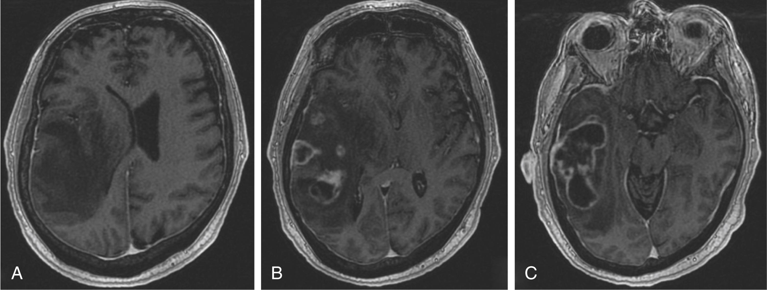 Fig. 2.2, Contrast enhanced Tl-weighted axial MRI view of a right temporal high-grade glioma. (A) Superior cut in which no tumor is visualized, but rather hypointense cerebral edema extending up to the frontal lobe. (B) Superior aspect of the enhancing mass is visualized in the temporal lobe. (C) Body of the mass is visualized in the inferior temporal lobe.