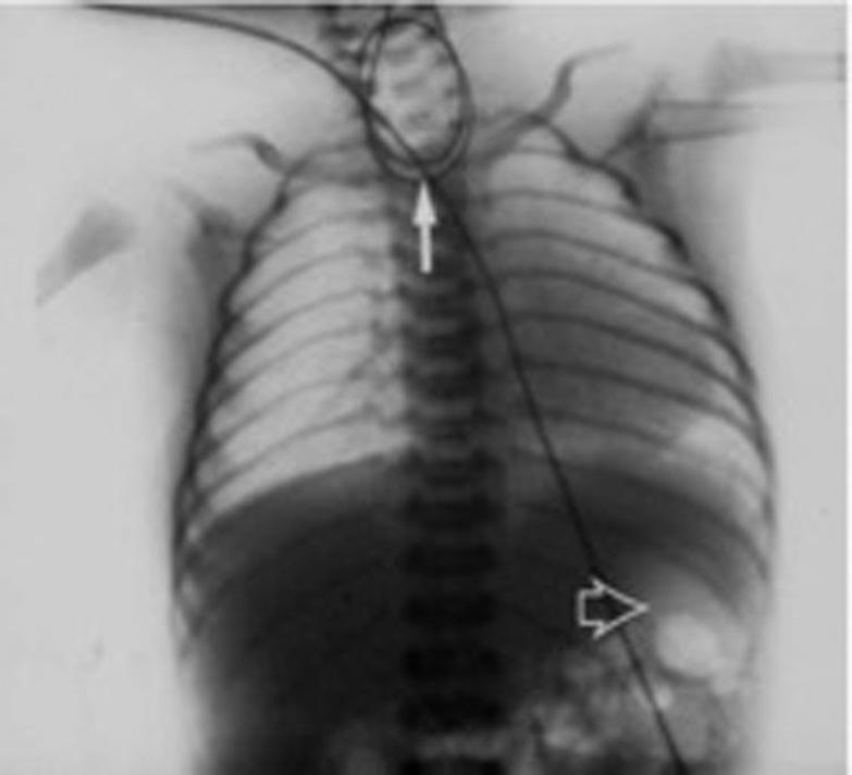 Fig. 21.1, Newborn with intolerance of initial feeding and inability to pass nasogastric tube (NGT), chest x-ray (CXR) shows tube coiled in proximal esophagus with presence of distal bowel gas.