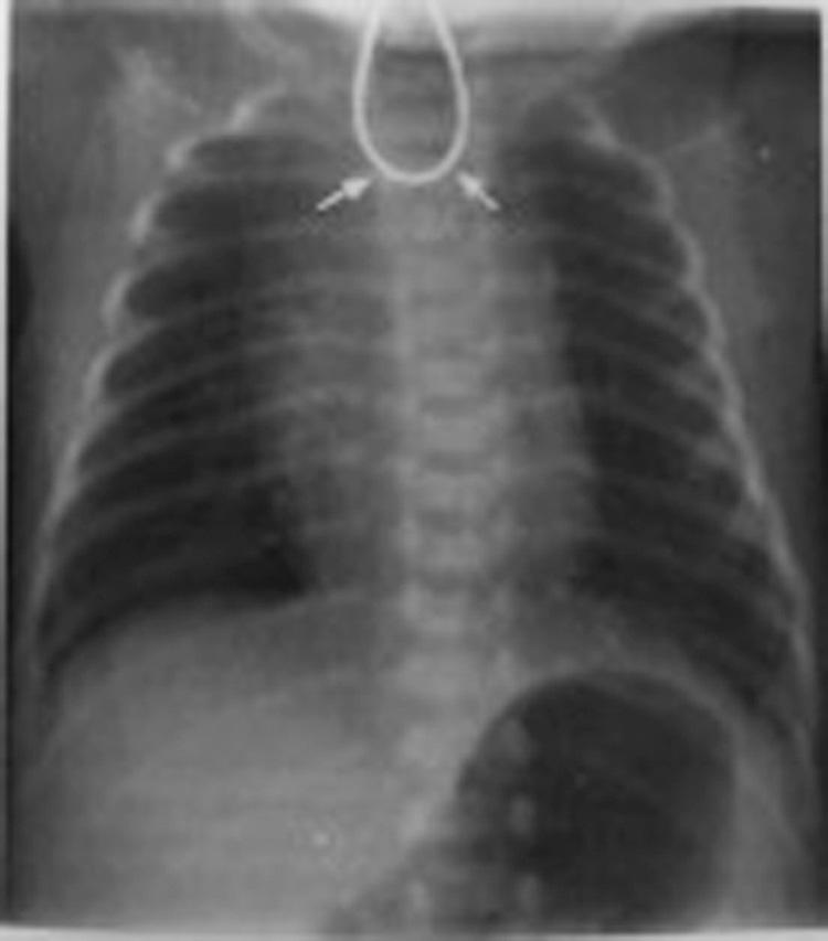 Fig. 21.2, Esophageal atresia; chest x-ray (CXR) with coiling of nasogastric tube (NGT) in the esophageal pouch.