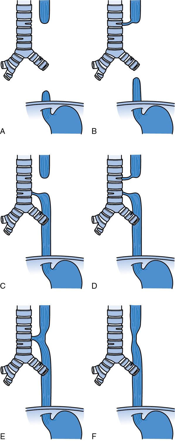 Fig. 21.3, Gross classification of anatomic patterns of esophageal atresia. (A) V atresia without TEF, associated with “long gap.” (B) Atresia with proximal TEF. (C) Atresia with distal TEF, the most commonly encountered form. (D) Atresia with a double fistula, proximal and distal. (E) TEF without atresia; H type fistula. (F) Esophageal stenosis.