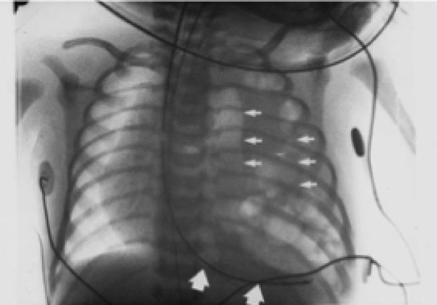 Fig. 21.5, CXR of neonate with left sided CDH; loops of bowel in the chest are outlined as well as an NGT above the diaphragm.