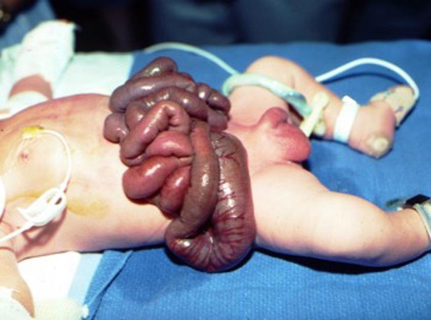 Fig. 21.6, Exposed bowel without any membrane covering, demonstrating inflammatory reaction and thickening of the bowel serosa in gastroschisis.