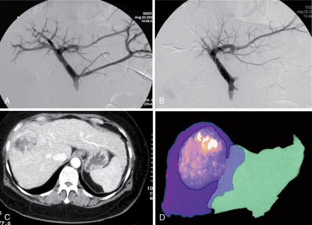 Figure 7-2, Portal vein embolization and hypertrophy of future liver remnant. (A) Portal vein embolization. (B) Post–portal vein embolization. (C) Left lobe hypertrophy on computed tomography. (D) Volumetric assessment of hypertrophy of the left lobe.
